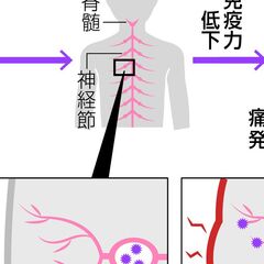 帯状疱疹がガチで大流…