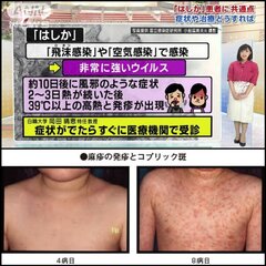 【注意】日本で麻疹(…